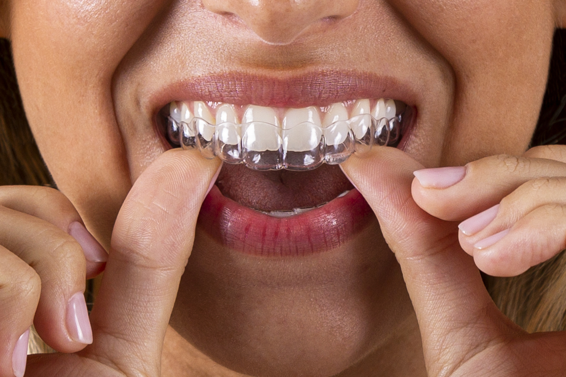 alineadores invisibles