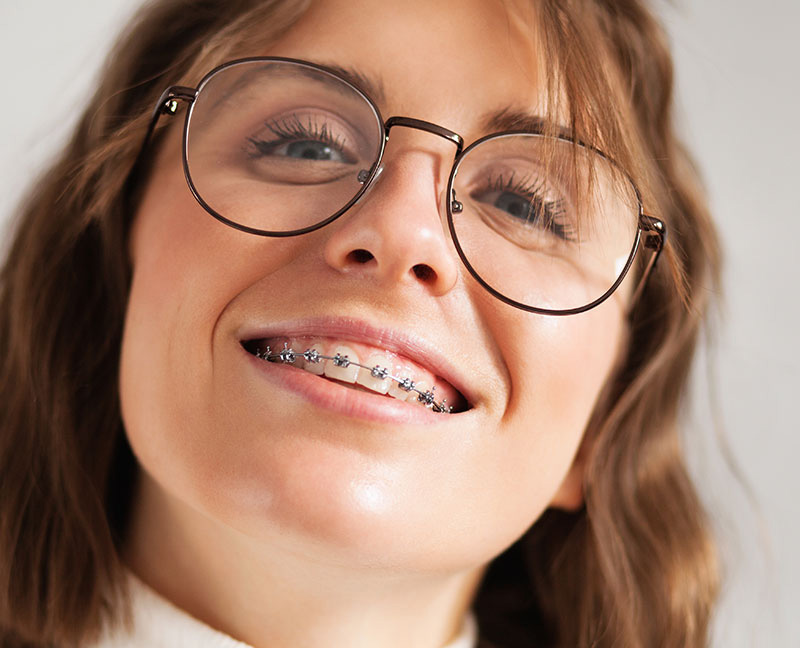 brackets autoligados