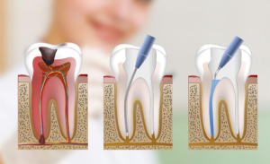 Fases de la Endodoncia Tipos y procedimientos
