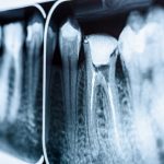 radiografías para endodoncia