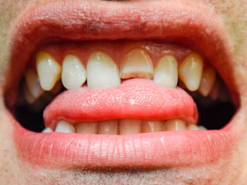 fractura urgencia dental