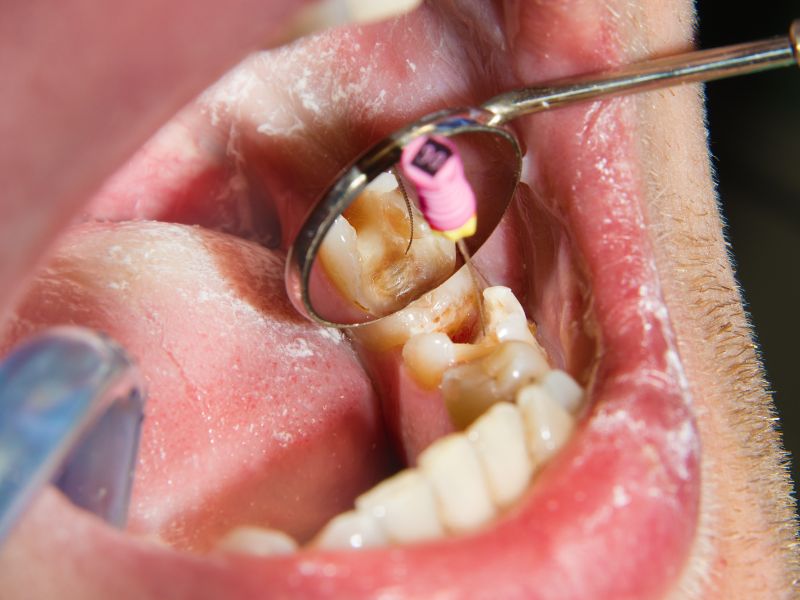 Endodoncia vs. Extracción Dental