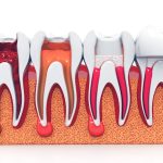 endodoncia y extracción
