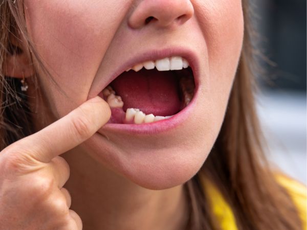 Envejecimiento Dental