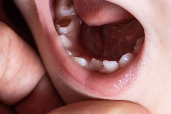 enfermedades bucales