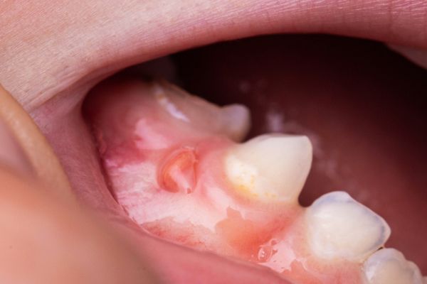 enfermedades bucales