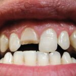pulpa dental