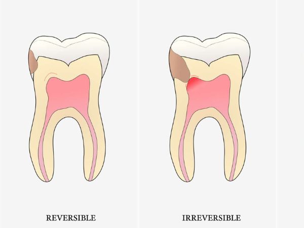 Pulpitis